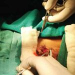 Understanding Adult Hypospadias Repair and Its Life-Changing Impact